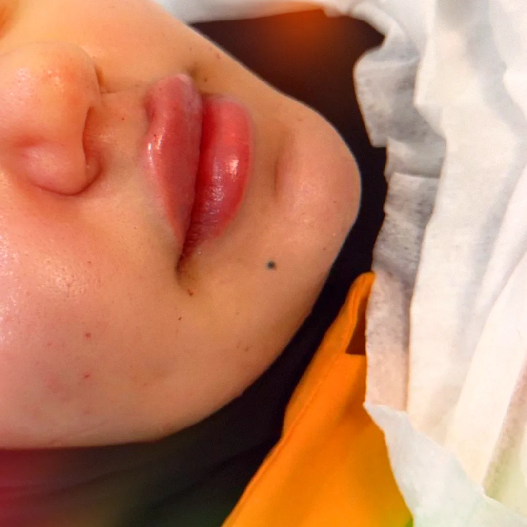 Dermal Fillers